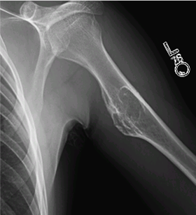 left proximal humerus osteochondroma icd 10